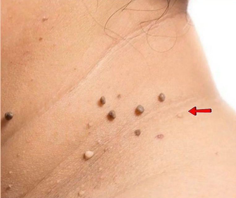 Skin Tag Removal at Facethetics Beauty, Delhi