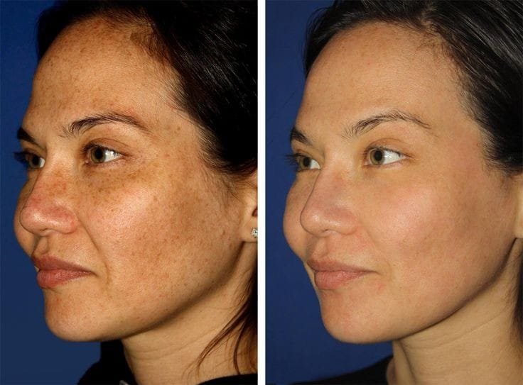 CO2 Fractional Laser Treatment at Facethetics Beauty