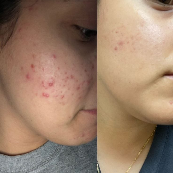 Acne Treatment at Facethetics Beauty