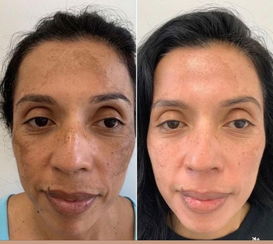 Cosmelan and Dermamelan Treatment at Facethetics Beauty