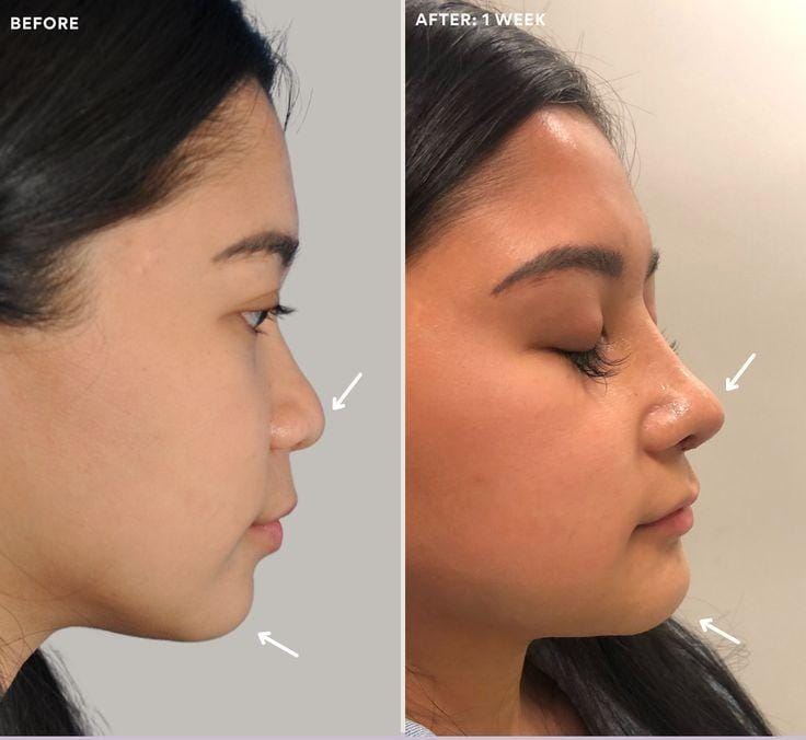 Nose Lift in Delhi – Achieve a Refined & Contoured Look with Facethetics Beauty at Facethetics Beauty, Delhi