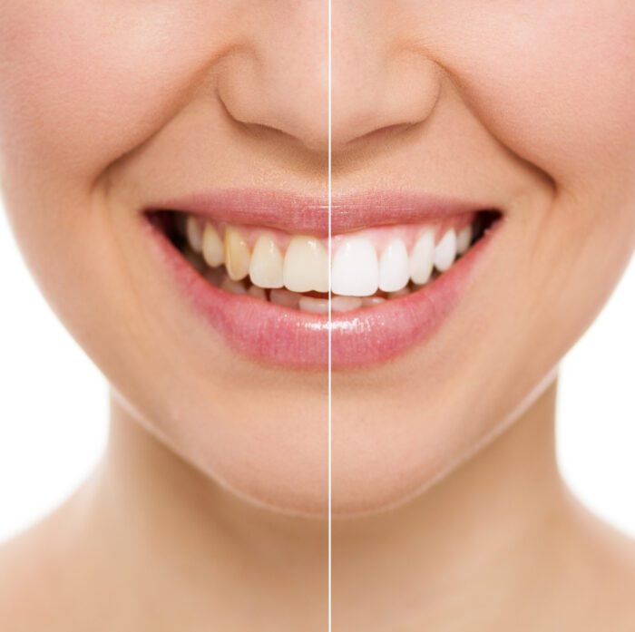 Teeth Whitening Treatment at Facethetics Beauty