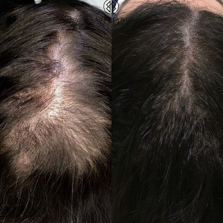 Mesotherapy for Hair at Facethetics Beauty