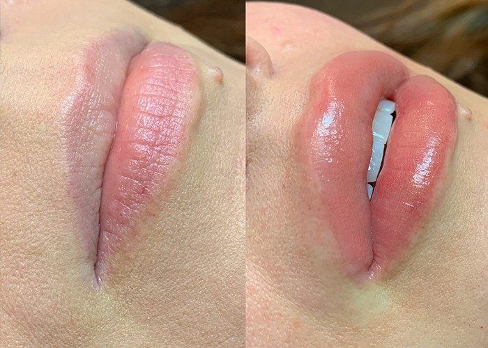 Permanent Lip Colour Treatment in Delhi – Get Naturally Beautiful Lips with Facethetics Beauty at Facethetics Beauty
