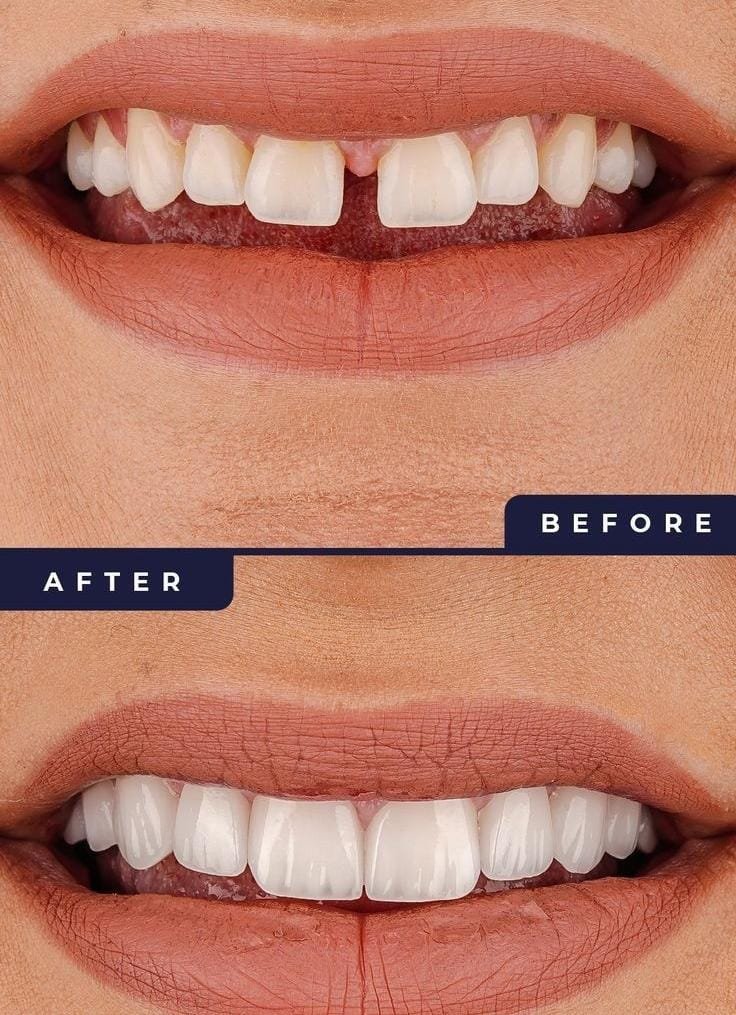 Veneers and Laminates at Facethetics Beauty