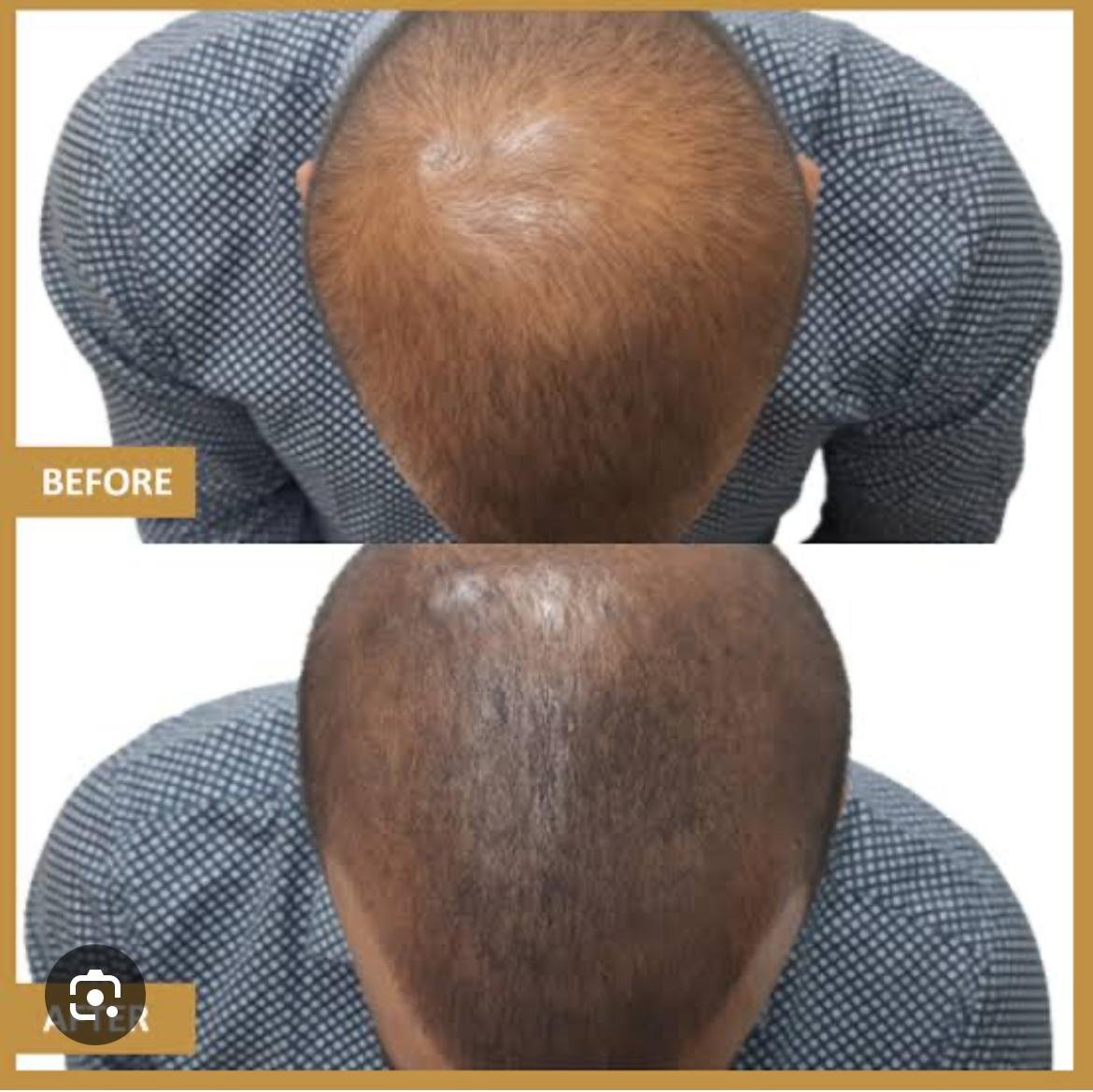 Scalp Pigmentation at Facethetics Beauty, Delhi