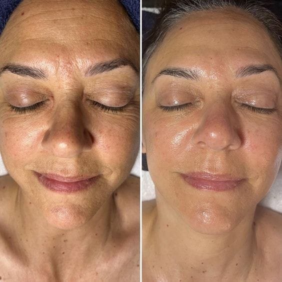 Mesotherapy for Skin Rejuvenation at Facethetics Beauty