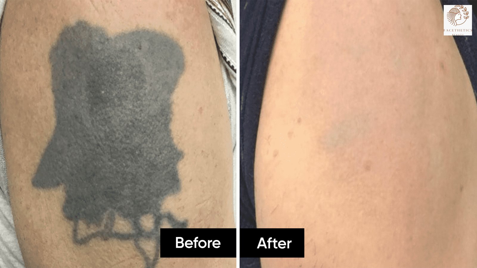 Tattoo Removal at Facethetics Beauty
