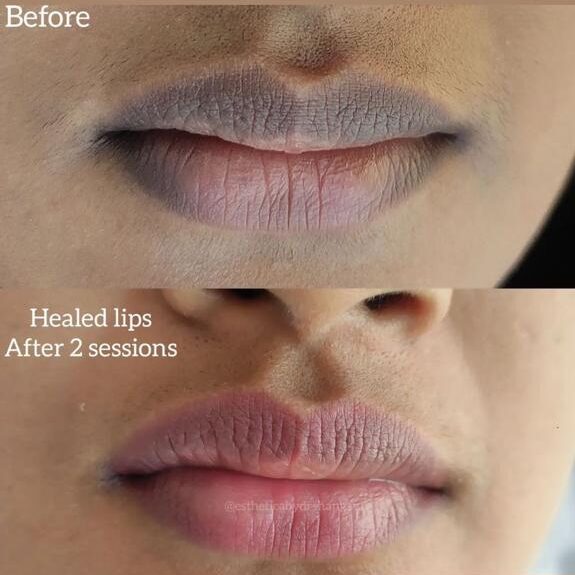 Lip Depigmentation at Facethetics Beauty