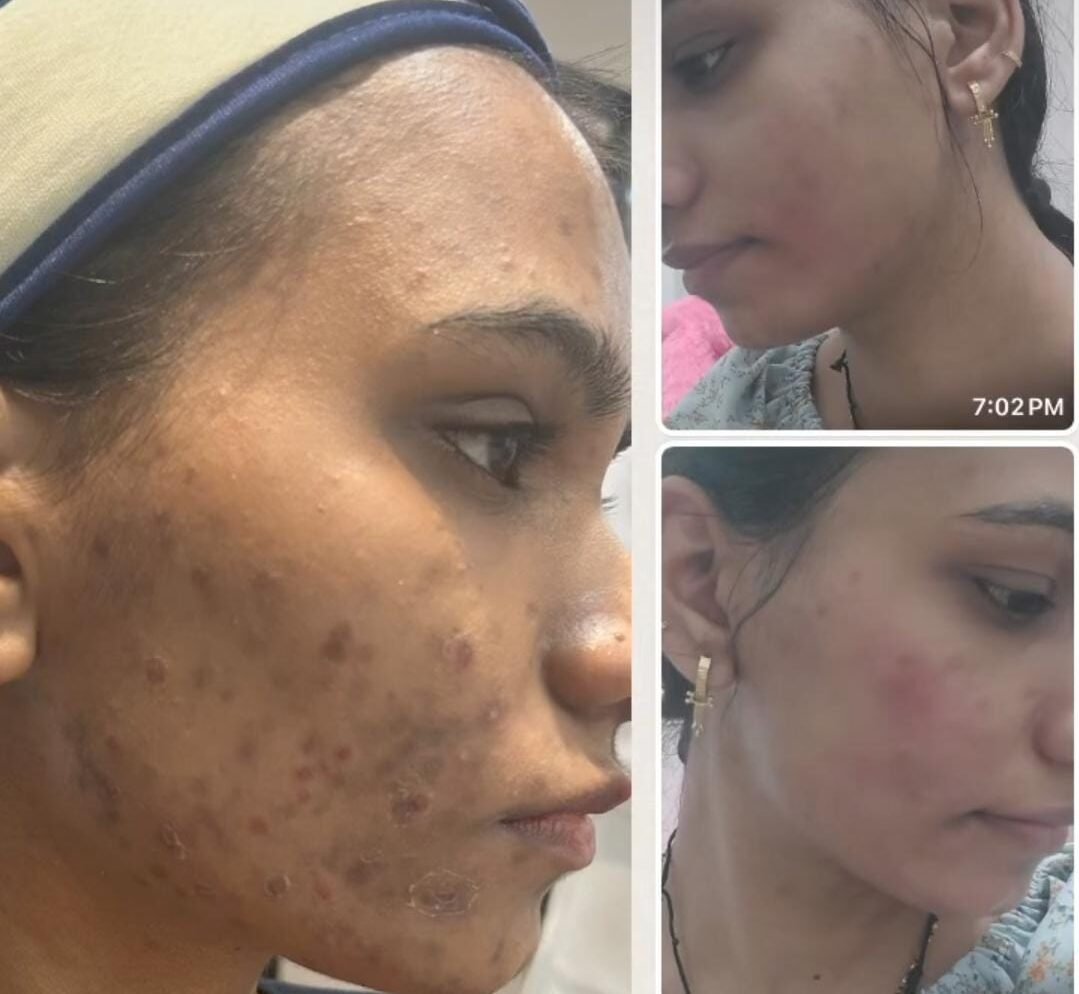 Korean Glass Skin Treatment at Facethetics Beauty
