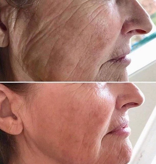 Collagen Boosters at Facethetics Beauty