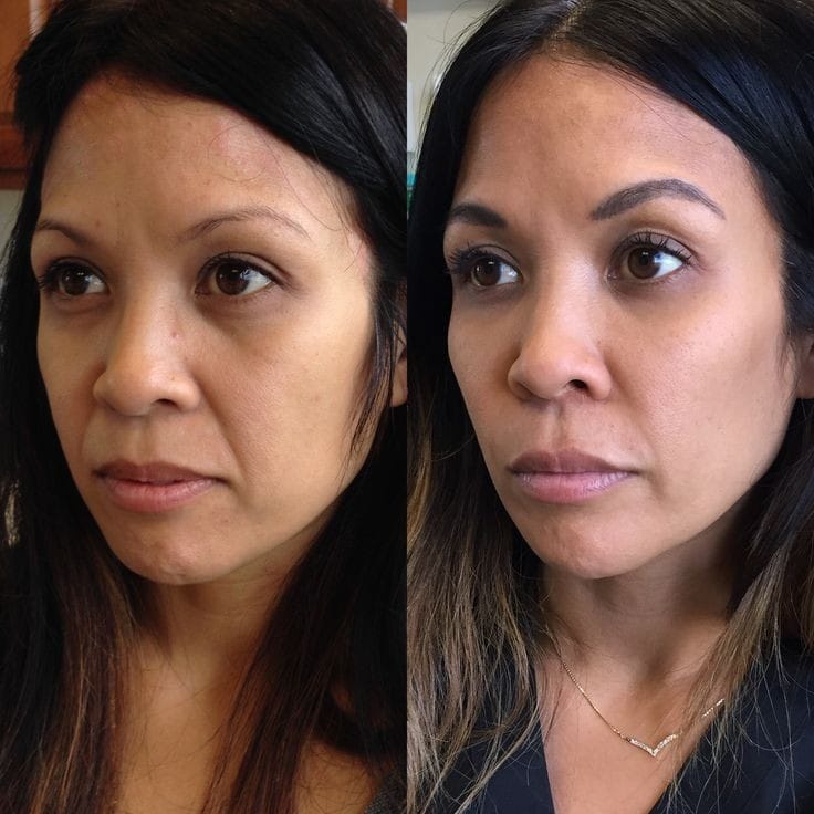 Nasolabial Fold Correction at Facethetics Beauty