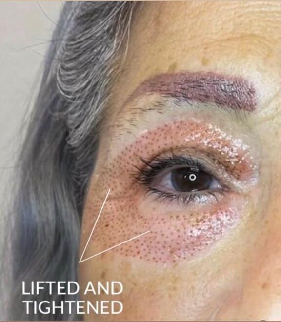 Plasma Fibroblasting at Facethetics Beauty