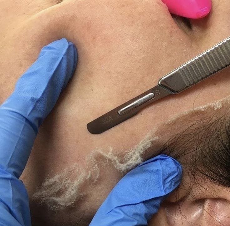 Dermaplaning Treatment at Facethetics Beauty