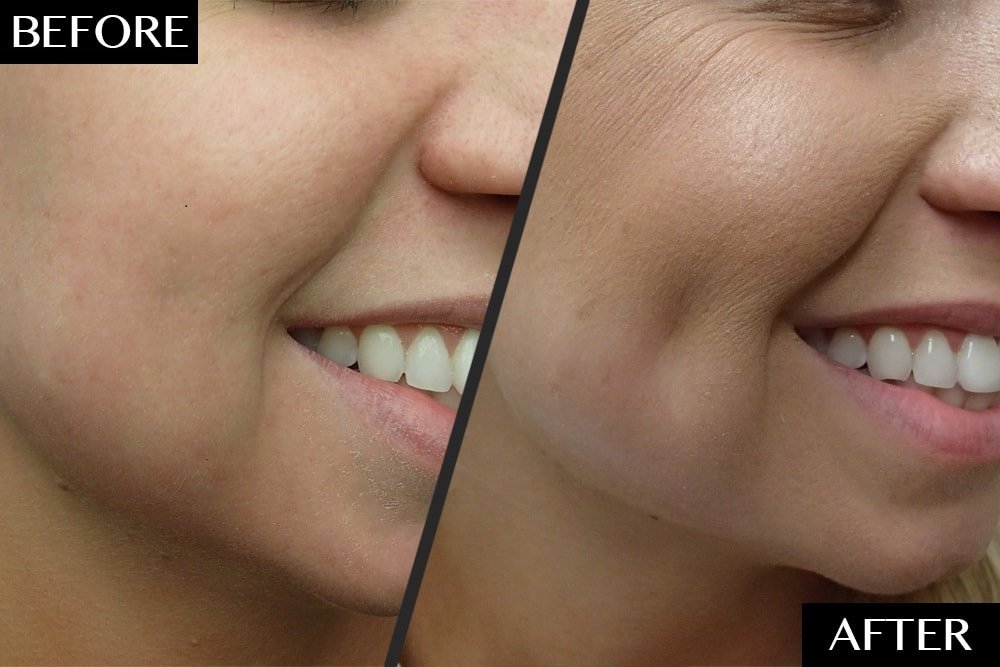 Dimple Creation Surgery