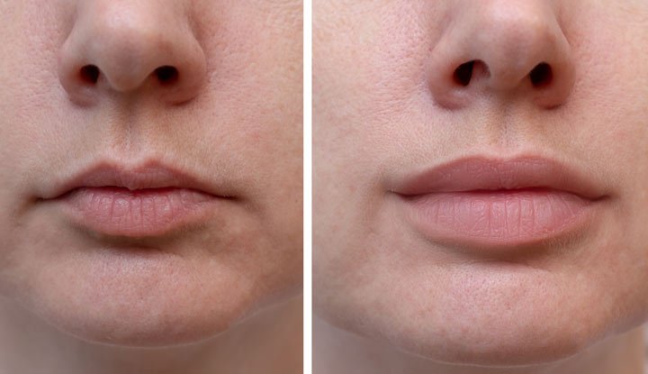 Best Lip Fillers