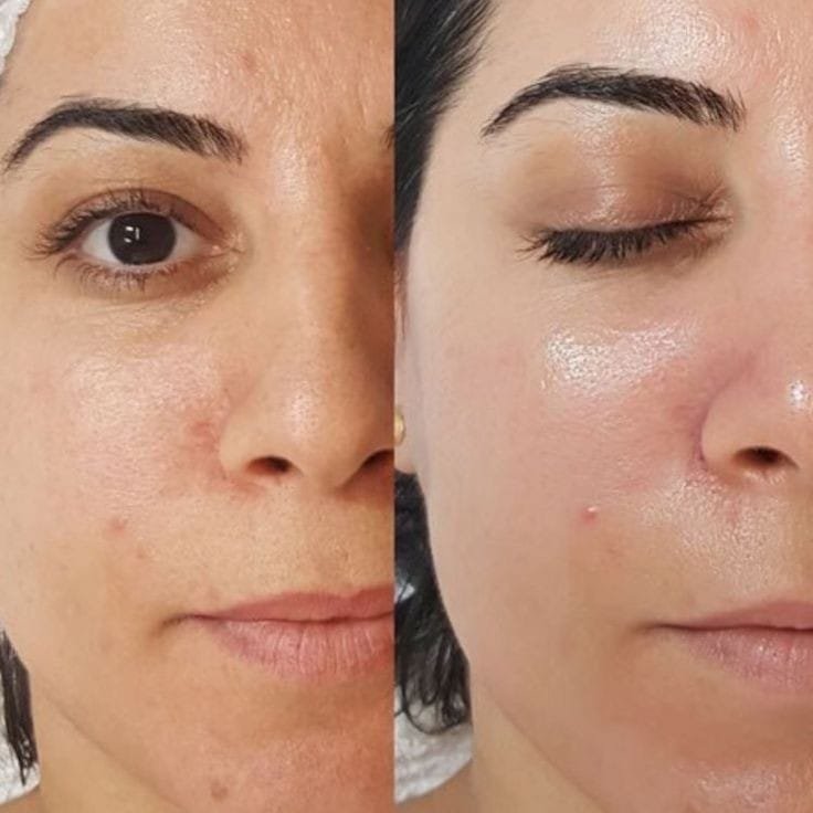 Nose Lift in Delhi, Achieve the Perfect Facial Harmony