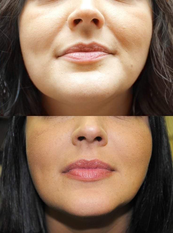 Is Botox the Best Treatment for Wrinkles? A Detailed Guide by Facethetics Beauty
