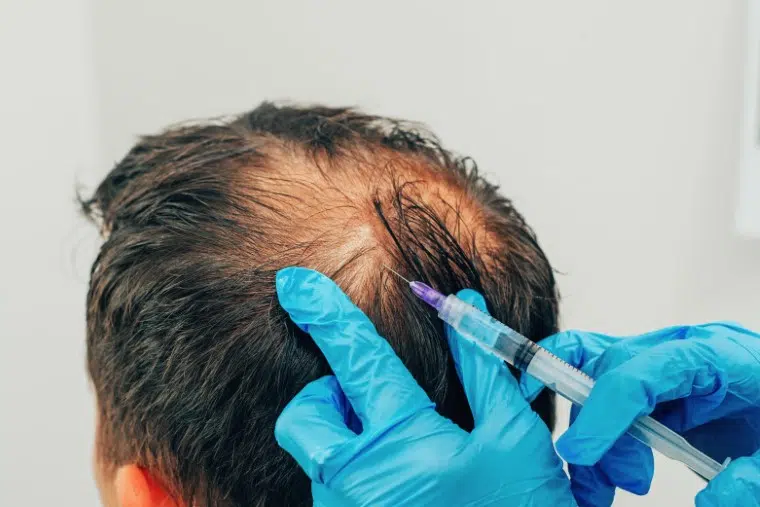 PRP Hair Treatment
