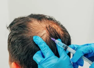 PRP Hair Treatment