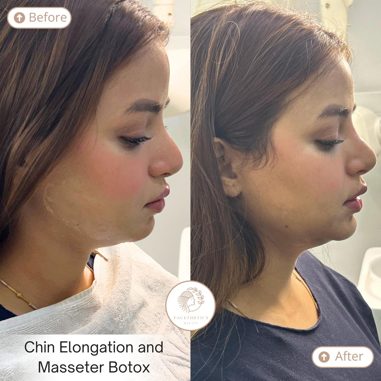 Masseter Botox Before After - Patient 1 - Facethetics Beauty Delhi