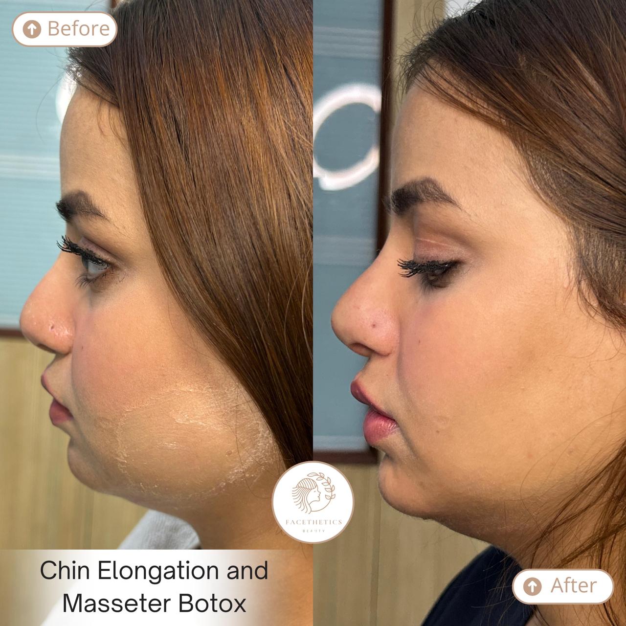 Masseter Botox Before After - Patient 2 - Facethetics Beauty Delhi
