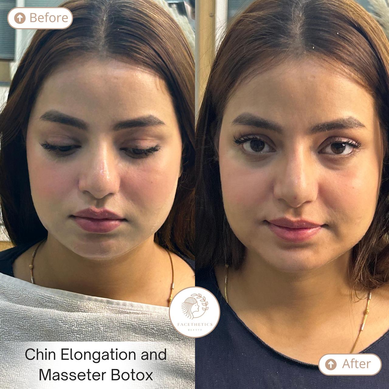 Jaw Botox Before After - Patient 3 - Facethetics Beauty Delhi